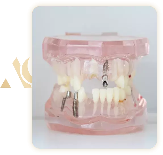 Implant dentaire Tunisie